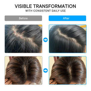 ProBliva Psoriasis Scalp Spray