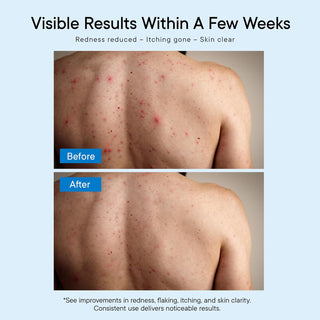 ProBliva Antifungal Body Wash Soap