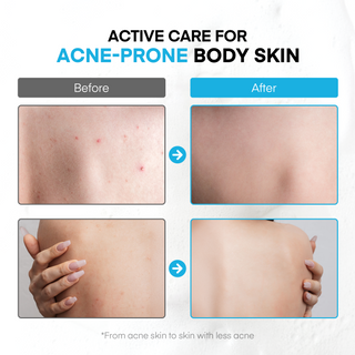 ProBliva Antibacterial & Acne Body Wash Treatment