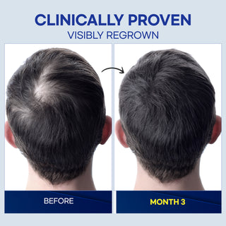 5% Minoxidil Hair Growth Treatment for Men - 2 fl oz - Made in USA